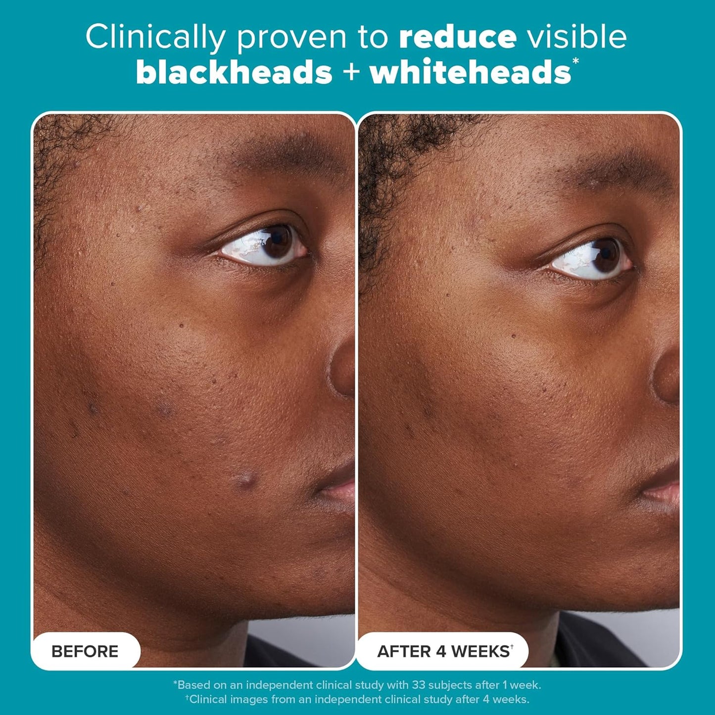 Paula's Choice SKIN PERFECTING 2% BHA Liquid Salicylic Acid Exfoliant-Facial Exfoliant for Blackheads, Enlarged Pores, Wrinkles & Fine Lines